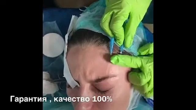 Подтяжка бровей