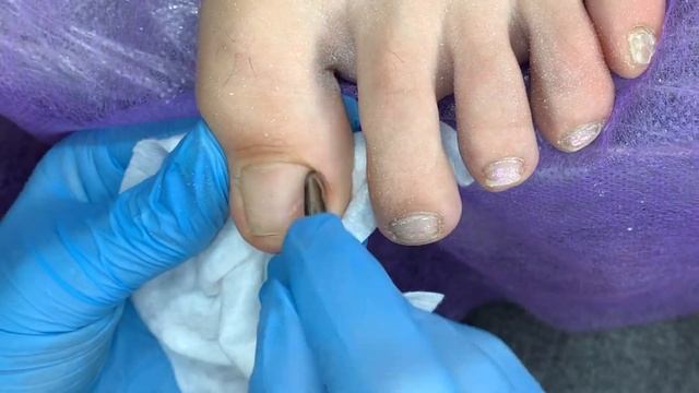 ПЕРЕНОСИЛА ГЕЛЬ-ЛАК. Обработка ОНИХОЛИЗИСА. ПЕДИКЮР аппаратом. ОНИХОЛИЗИС