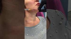 Коррекция подбородка филлерами Стилейдж, с помощью атравматической канюли. Обучение косметологов.