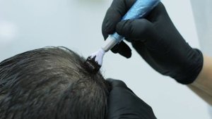 Трихопигментация головы роллером - коррекция алопеции