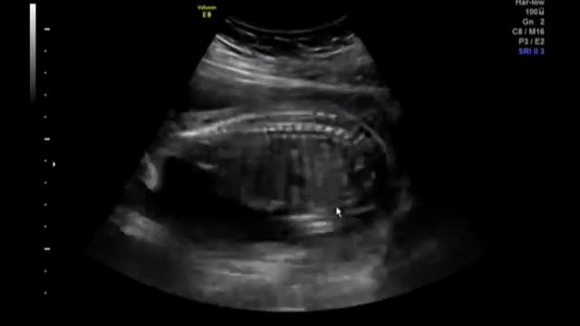 0324090832СтандартS Video4 D УЗД 20 недель смотреть онлайн