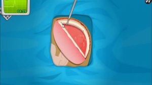 Challenging Journey to a Successful Epilepsy Surgery in Operate Now | Gameplay Recording