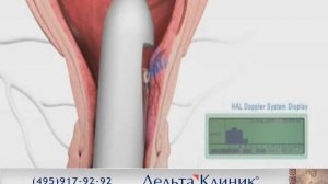 Лечение геморроя в Дельта Клиник. Дезартеризация. Бескровное лечение геморроя.