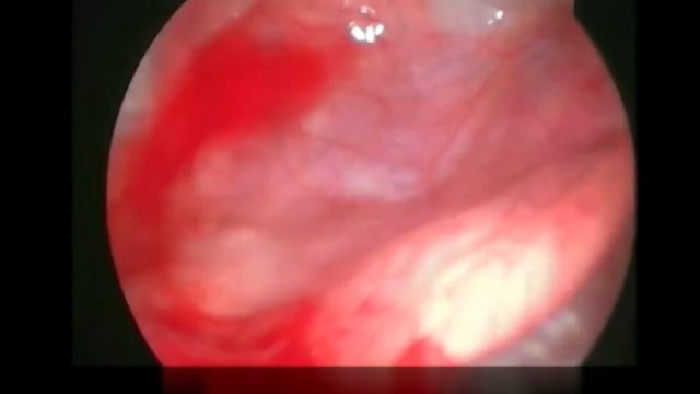 Микрогайморотомия.mp4 смотреть онлайн