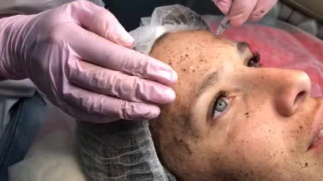 Пилинг лица B-tox Peel с использованием альгинатной маски смотреть онлайн