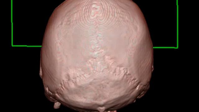 Кранио-орбитальное ранение смотреть онлайн