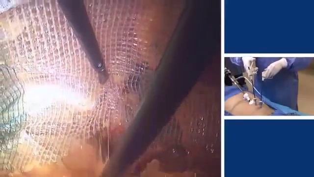 Подробное видео про применение самофиксирующейся сетки ProGrip