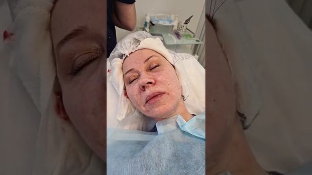 SUPERlift за 30 минут. Нитевое омоложение нитями с насечками смотреть онлайн