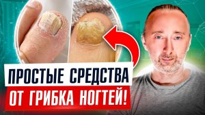 Как навсегда избавиться от грибка ногтей? ВОТ Вам РЕЦЕПТЫ! Истинные причины грибка ногтей и стоп!