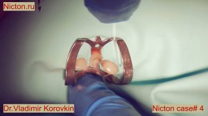 Кейс раббердам Nictone . Bild UP 22d . Кейс#4.