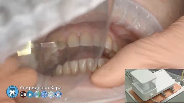 Professional oral hygiene -case 016 Acteon DTE Dentsply Coxo Floweis 3M KerrHawe (FHD multistream)