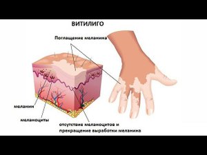 Витилиго. Лечение Fohow. Здоровье с ЦСТО "Жемчужина Востока".