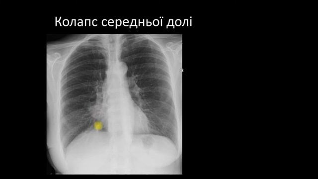 CXR: Лекція 6 Ателектаз смотреть онлайн