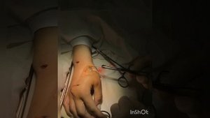 транспозиция сухожилия собственного разгибателя второго пальца кисти