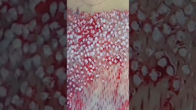 Пересадка волос в Москве #hairtransplant #пересадкаволос смотреть онлайн