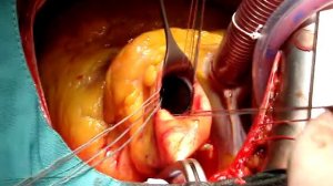 Імплантація механічного протезу аортального клапана