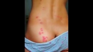 Укусы клопов на теле  - фото