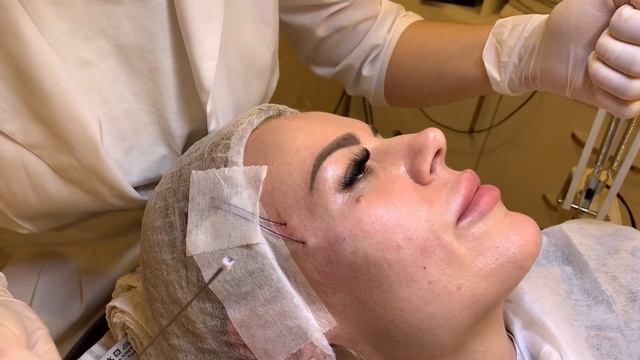 НИТИ/ ПОДТЯЖКА ЛИЦА в 35/ МГНОВЕННЫЙ ЭФФЕКТ/VLOG #51 смотреть онлайн