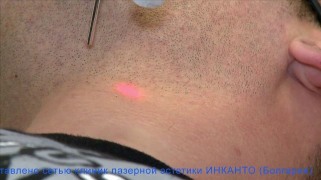 Лазерная эпиляция часть 2