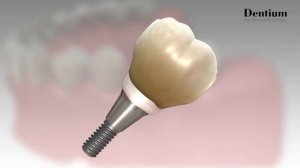 Протезирование на имплантах системы Dentium.