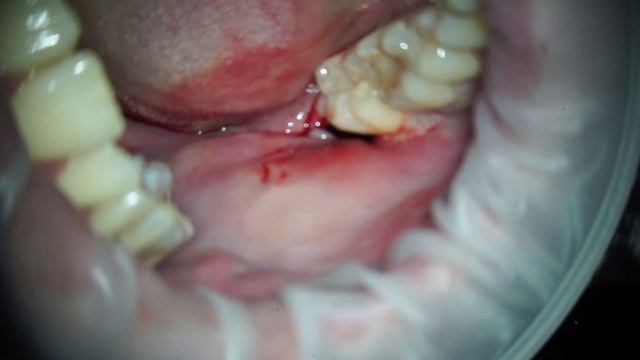 Удаление зуба мудрости смотреть онлайн