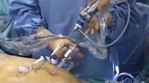 Миниинвазивная холецистэктомия