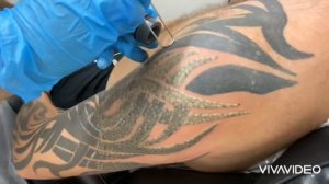 Laser Tattoo Removal Video Tribal Tattoo