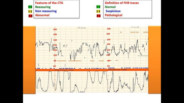 differentiation between fetal and maternal pulse in CTG смотреть онлайн