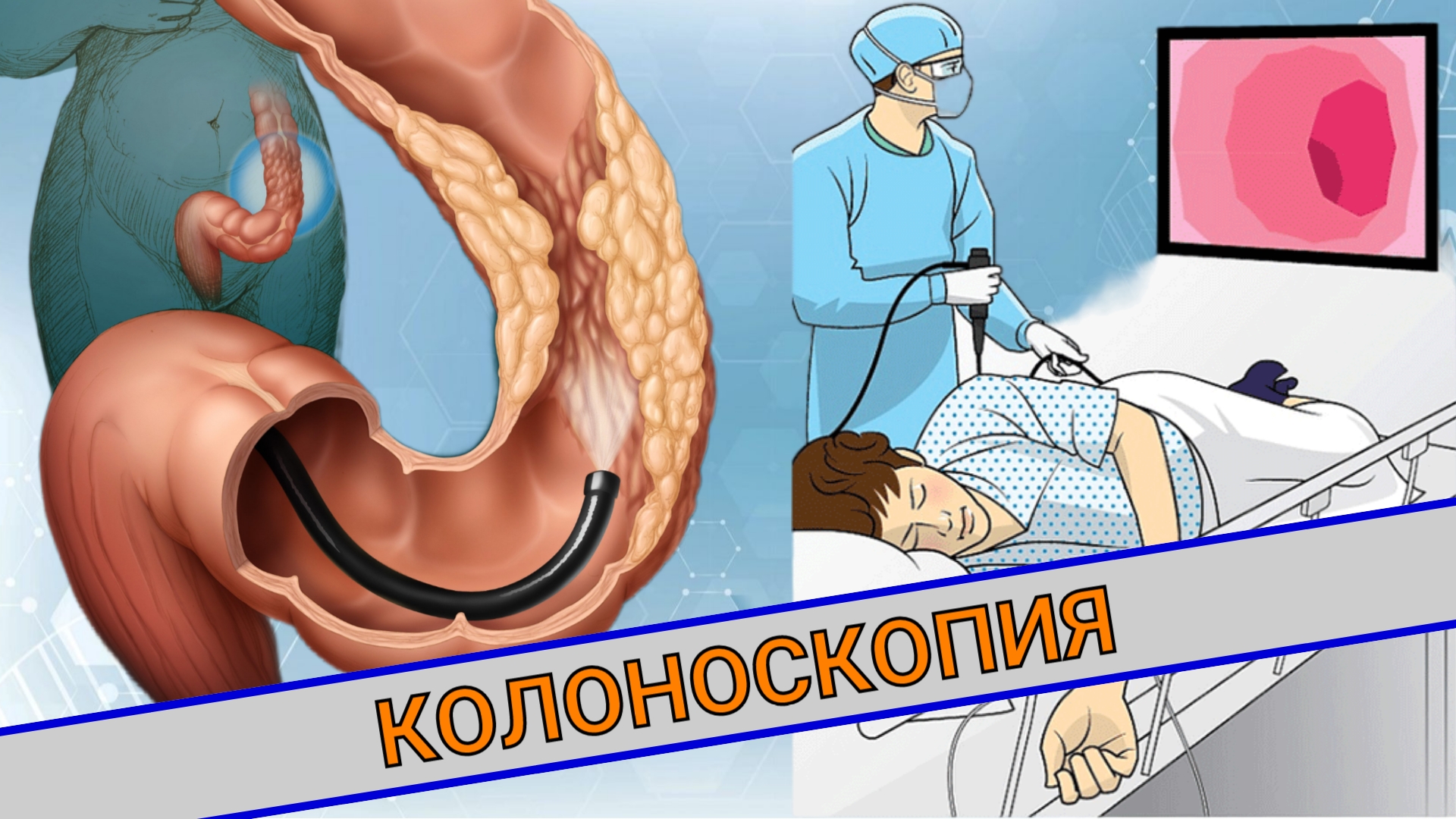 КОЛОНОСКОПИЯ || ЧТО ЭТО? КАК ПОДГОТОВИТЬСЯ?