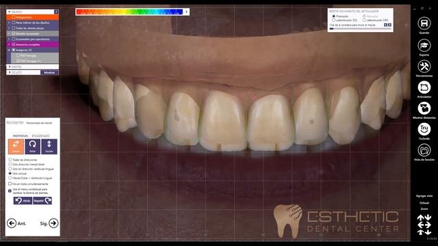 EXOCAD in action! Esthetic Dental Lab! смотреть онлайн