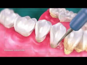 Удаление зубных отложений и сглаживание поверхности корня