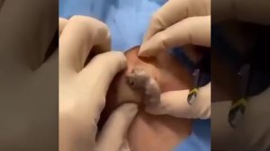 Удаление эпидермальной кисты