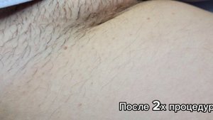 Электроэпиляция