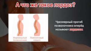 Кифоз и лордоз. Разница и лечение