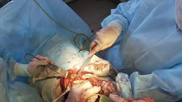 Дренирование по Вишневскому. Гнойный холангит.Холецистит.Городская больница Кокшетау