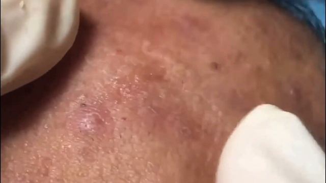 Чистка лица. Face cleansing. смотреть онлайн