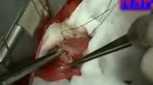 Видео материал ' Удаление паразитов'