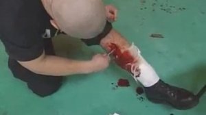 как зашить рану в полевых условиях.