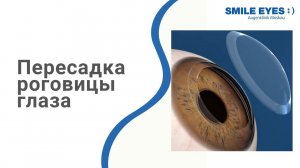 Пересадка роговицы глаза (задняя послойная кератопластика) в Москве