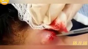 Прыщи на шее. Лечение прыщей на шее.
