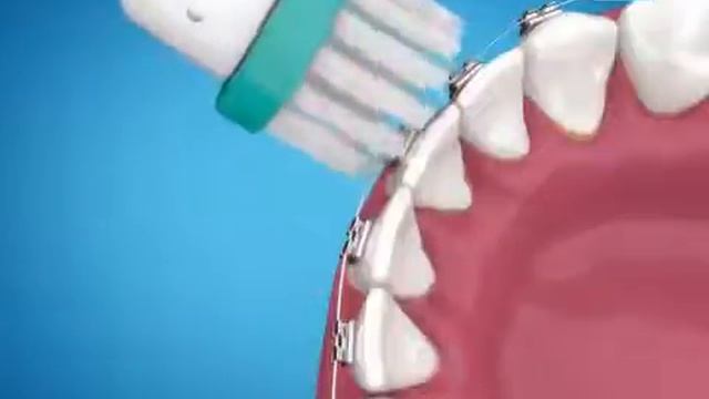 ראש מברשת שיניים אורתודונטית  Oral-B ORTHO CARE