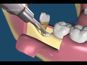 удаление зуба мудрости полностью покрытого костью