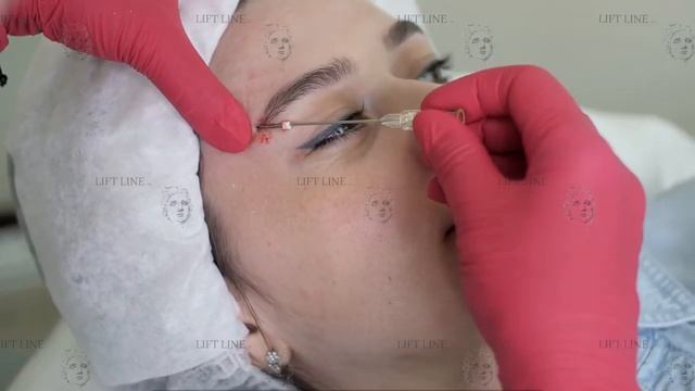 Лифтинг верхнего века нитями Lift Line Nata. Эффект "лисьи глазки"