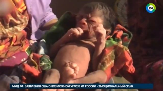 В Бангладеш родился младенец с лицом 80 летнего старика смотреть онлайн