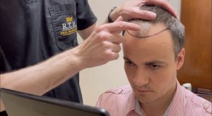 Коррекция передней линии роста волос.