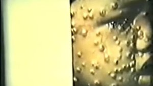 Ветряная оспа 2