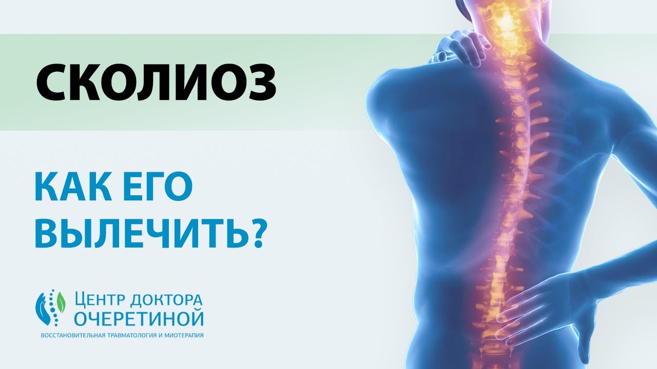 Как БЫСТРО вылечить СКОЛИОЗ? | Топ УПРАЖНЕНИЙ для ЛЕЧЕНИЯ СКОЛИОЗА