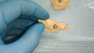 протезирование зубов