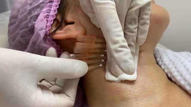 Мононити для укрепления кожи шеи