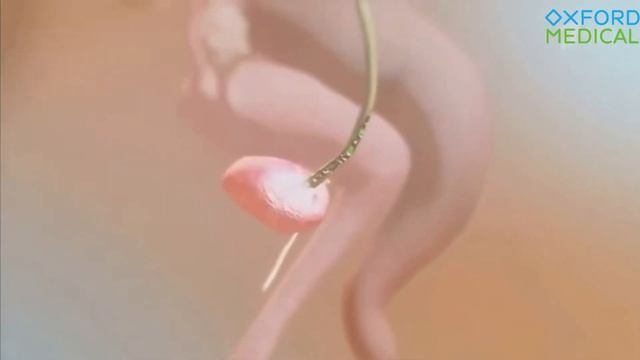 ЧЕМ ОПАСЕН ПИЕЛОНЕФРИТ? смотреть онлайн